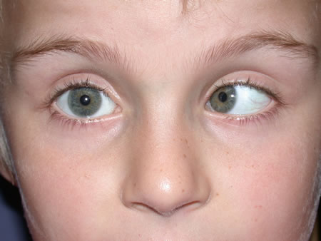 PAEDIATRIC OPHTHALMOLOGY