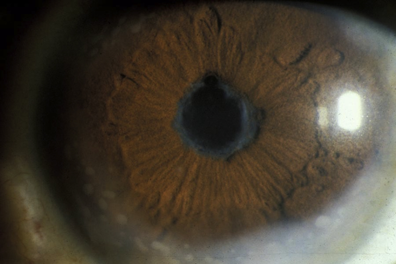 Uveitis