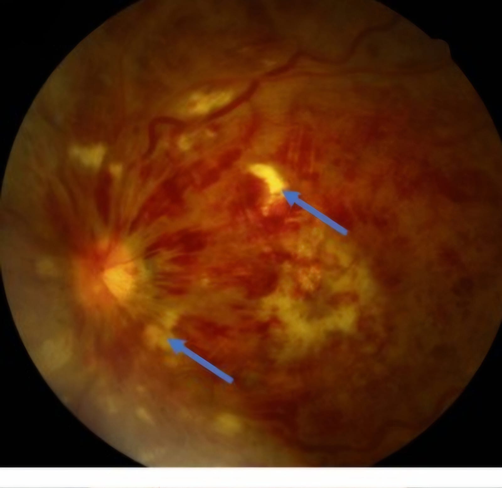 Central Retinal Vein Occlusion. (CRVO)